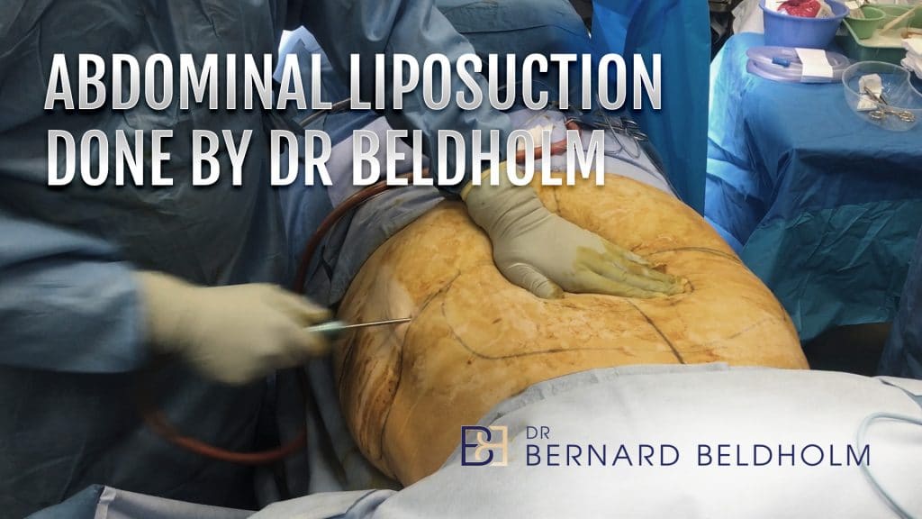 Abdominal Liposuction Done by Dr Beldholm