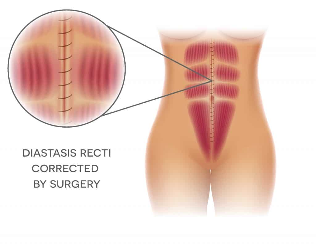 Diastasis Recti Corrected by Surgery