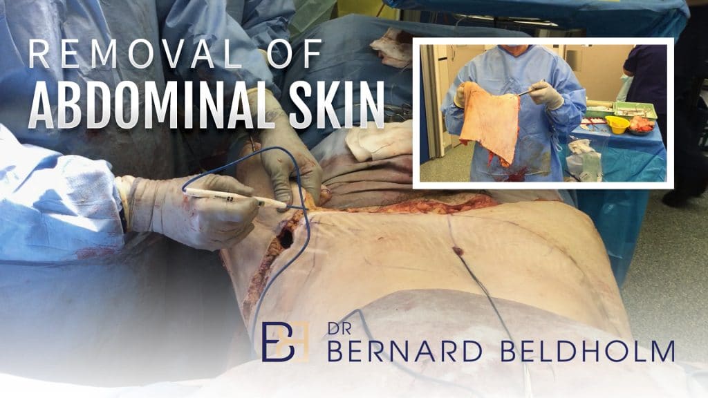 Removal of Abdominal Skin