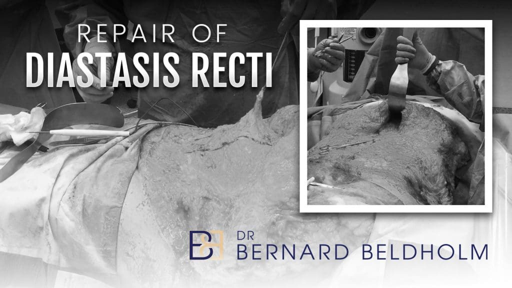 Repair of Diastasis Recti