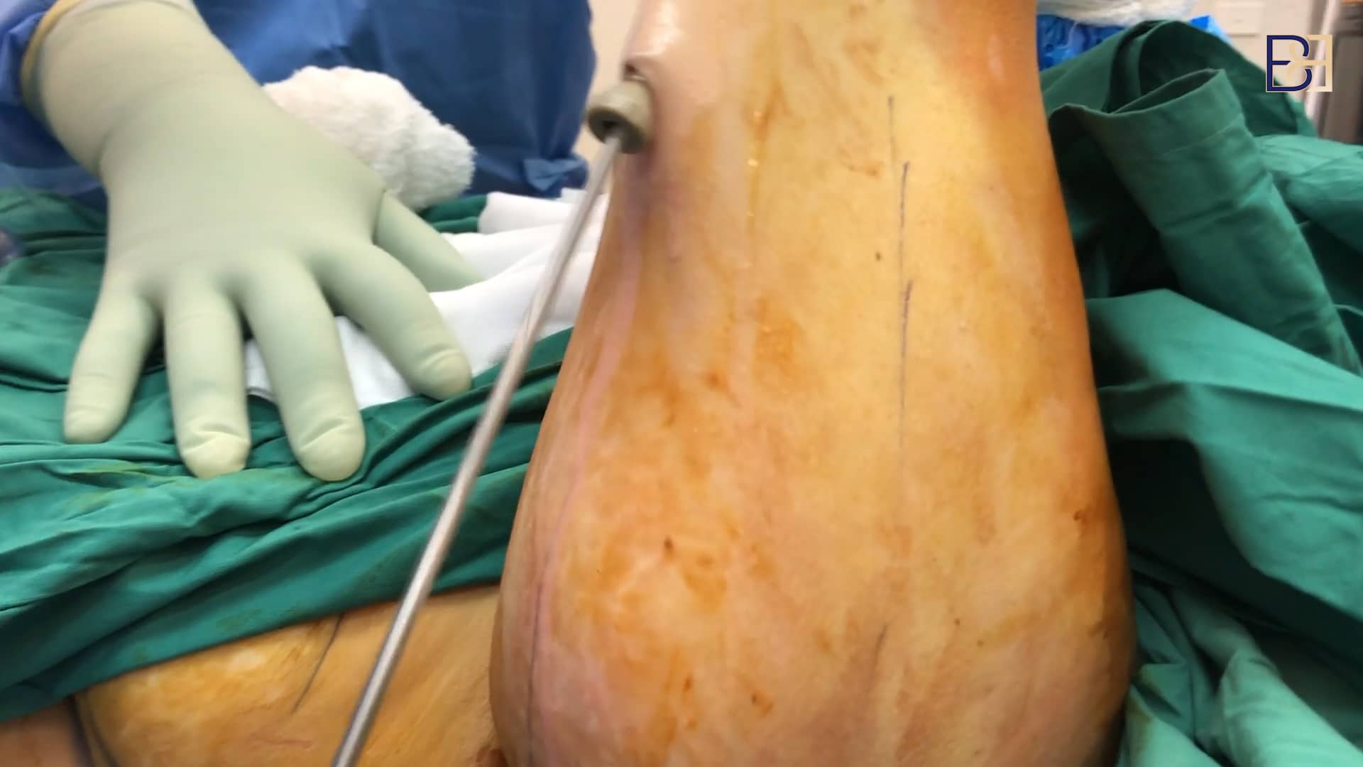 Operation Guide: Brachioplasty with VASER Liposculpture