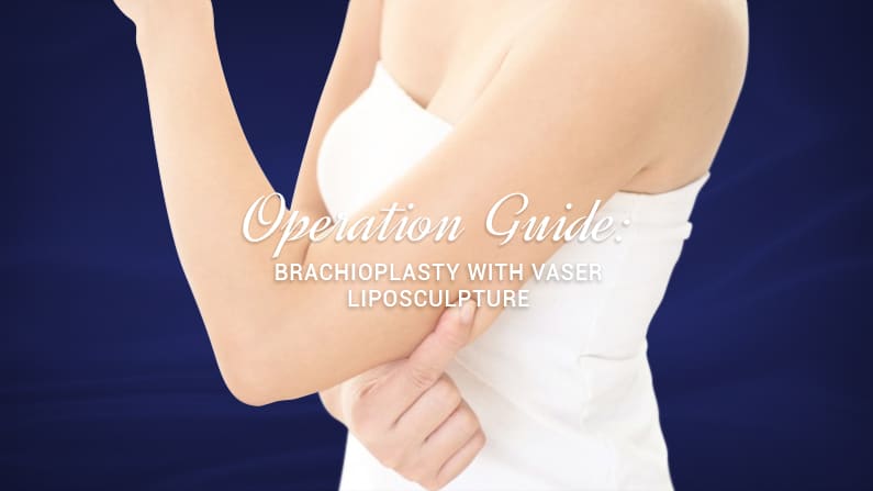 Operation Guide: Brachioplasty with VASER Liposculpture