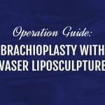 Arm Lift Surgery Guide