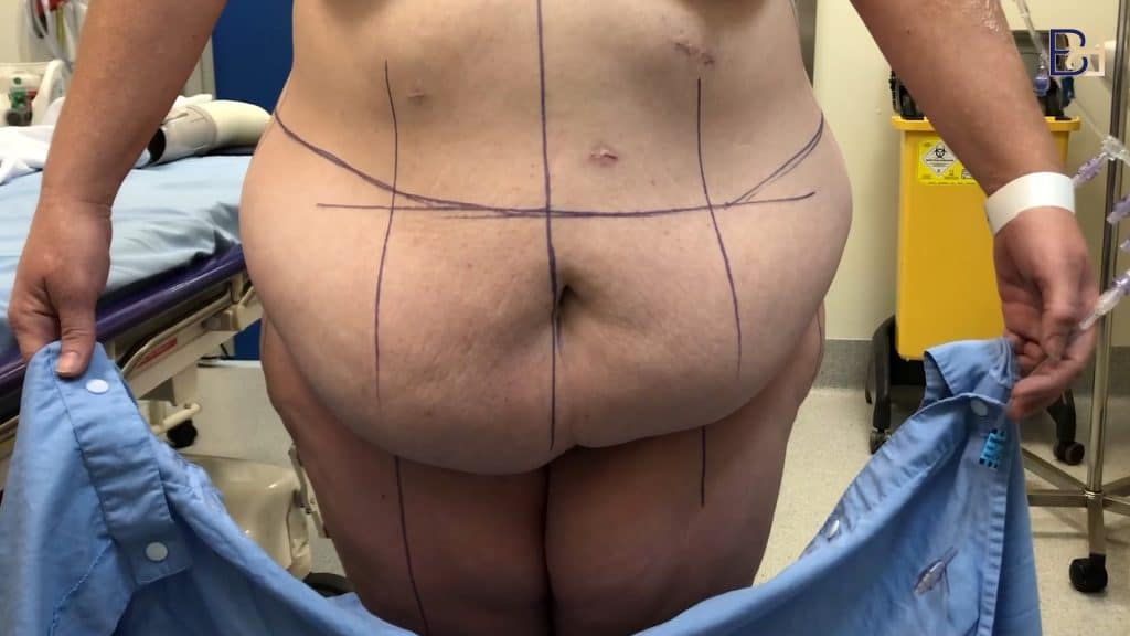 Achieve a Contoured and Youthful Midsection with a Belt Lipectomy