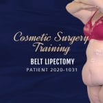 Operation Guide: Belt Lipectomy Surgery After Weight Loss