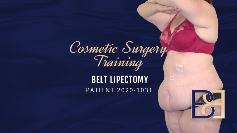 Operation Guide: Belt Lipectomy Surgery After Weight Loss