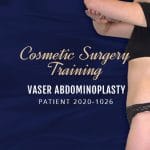Patient 2020-1026 VASER Abdominoplasty