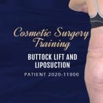 Patient 2020-11000 Buttock lift and Liposuction - Cosmetic Surgery Training