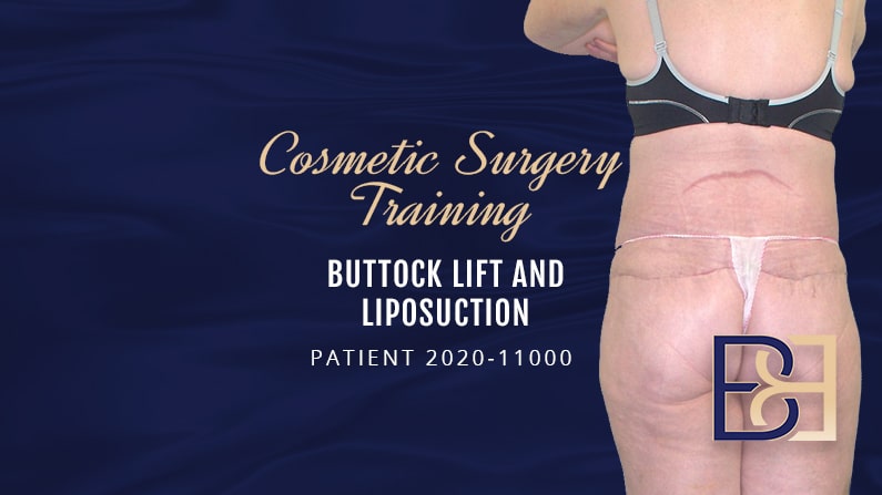 Patient 2020-11000 Buttock lift and Liposuction - Cosmetic Surgery Training