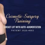 Patient 2020-4003 - Cosmetic Surgery Training - Breast Lift Auto Augmentation