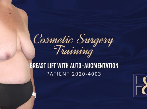 Patient 2020-4003 - Cosmetic Surgery Training - Breast Lift Auto Augmentation