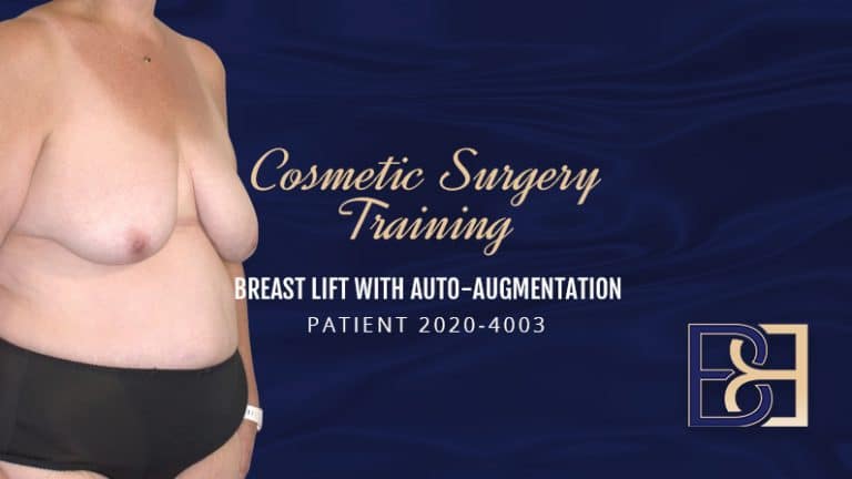 Patient 2020-4003 - Cosmetic Surgery Training - Breast Lift Auto Augmentation