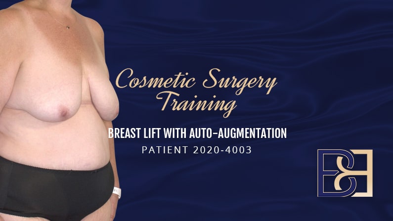 Auto Augmentation Breast Lift Surgery Guide