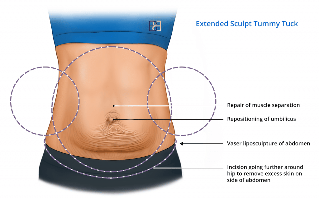 Extended Sculpt Tummy Tuck