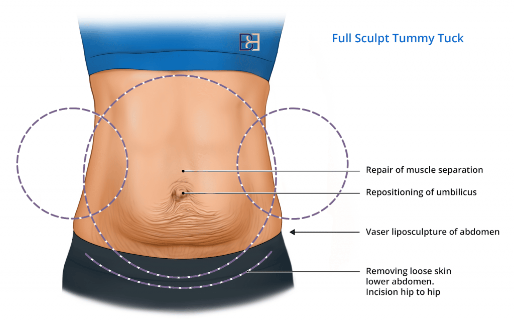 Tummy Tuck with Muscle Repair