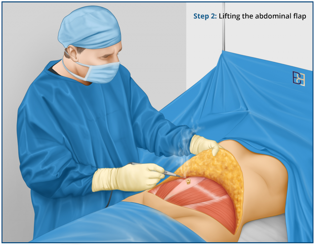 Lifting the Abdominal Flap