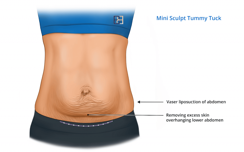 Mini Sculpt Tummy Tuck