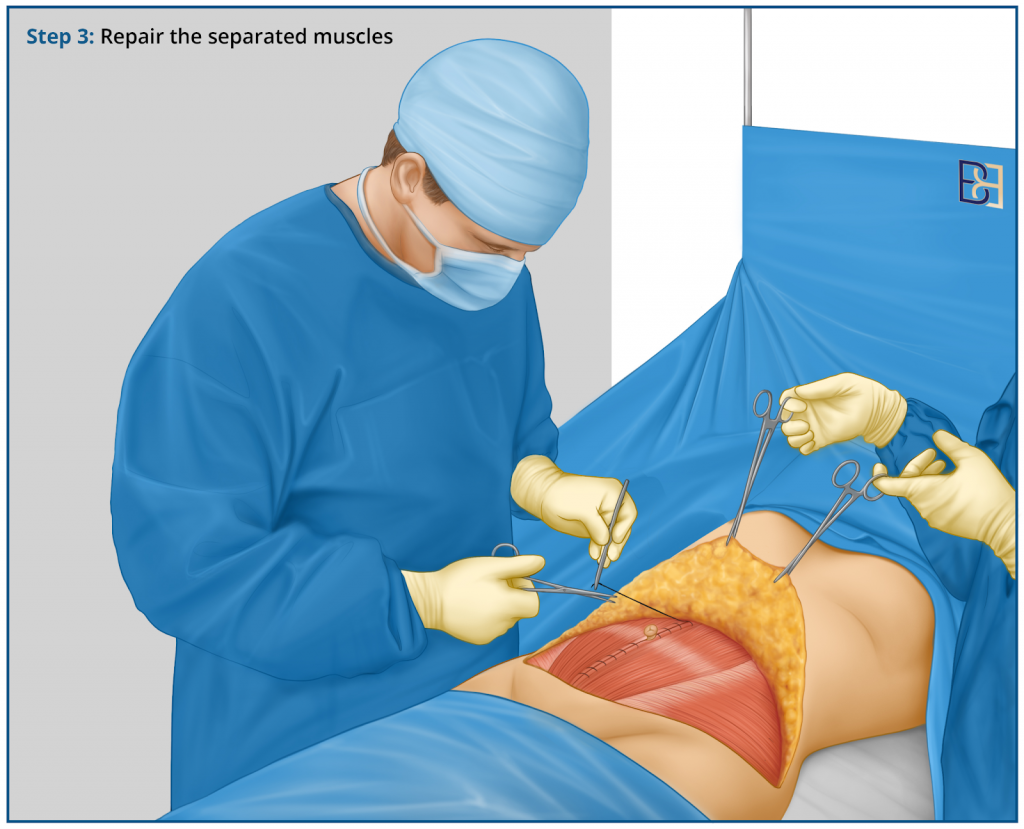 Repair the separated muscle