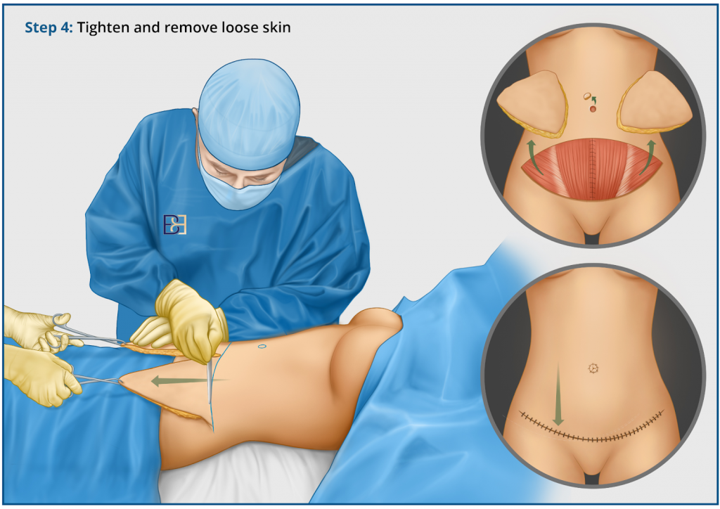 Tighten and remove loose skin