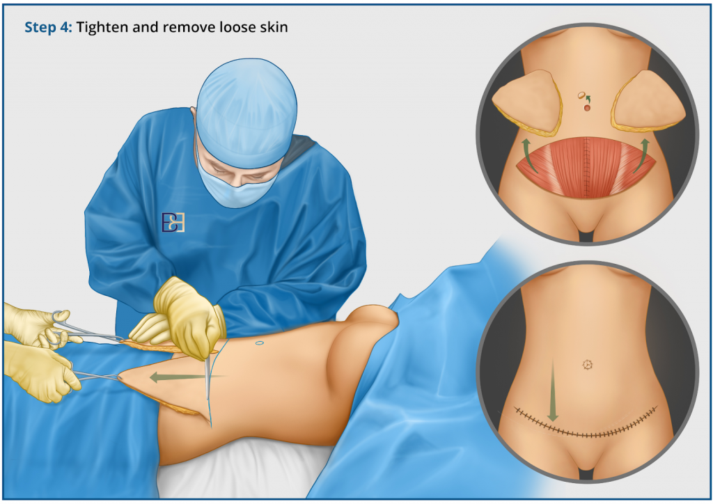 Does liposuction tighten loose skin? - Aesthetic Surgical Images