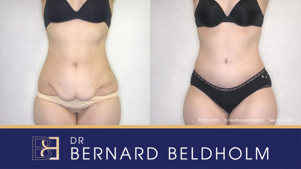 Patient 2019-1000 Abdominoplasty - Before & After Results