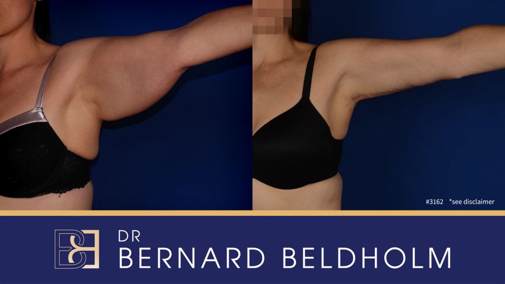 Brachioplasty Arm Lift Surgery Before & After Results Cooks Hill, NSW