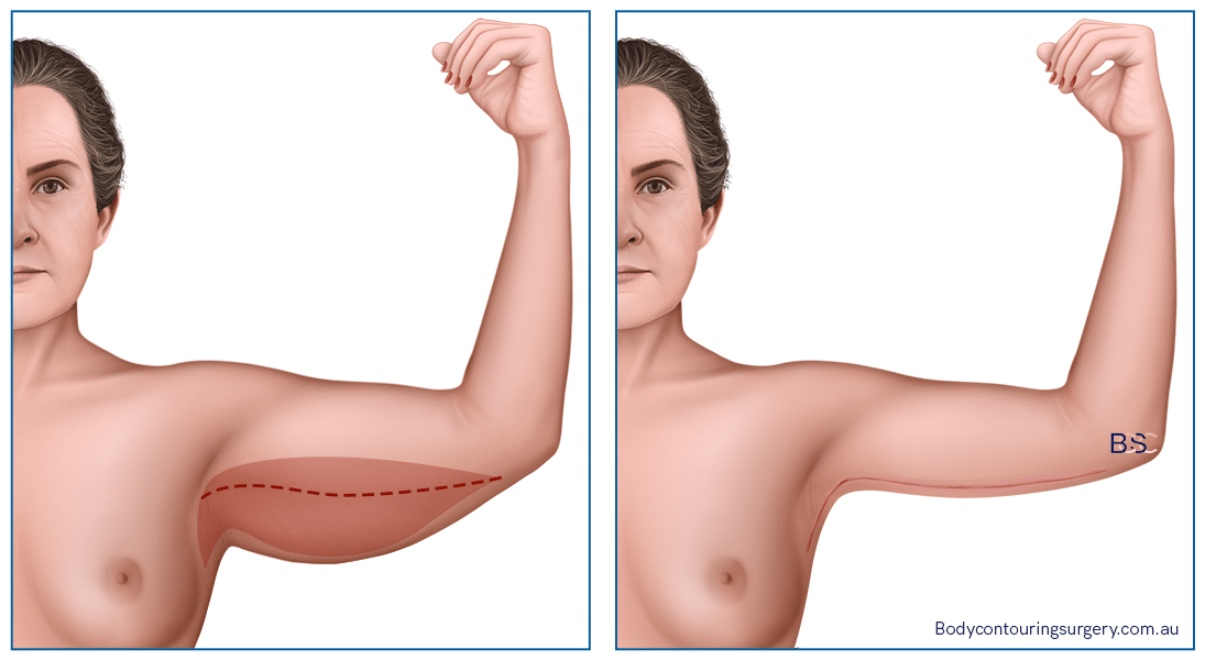 Extended Brachioplasty