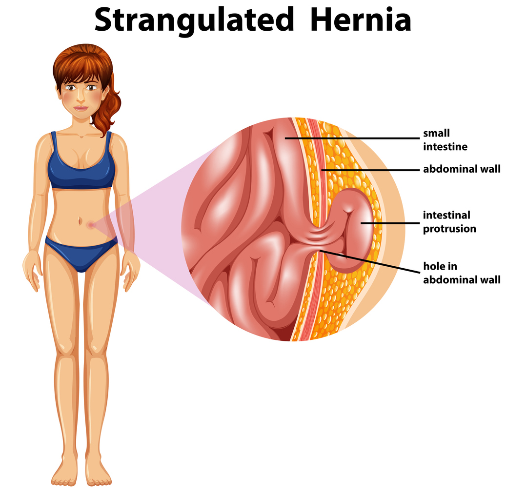 Strangulated hernia