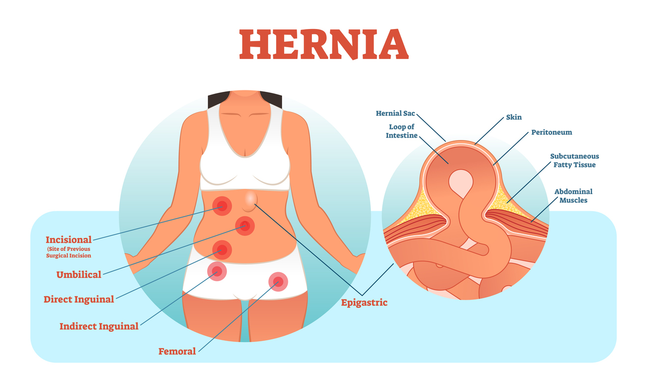 Postpartum umbilical hernia/tummy tuck - June 2020 Babies