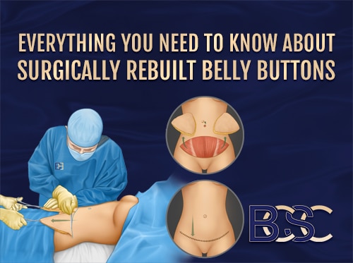 Everything You Need to Know about Surgically Rebuilt Belly Buttons