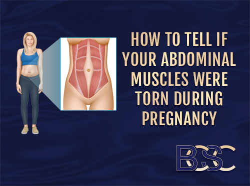 How to Tell if Your Abdominal Muscles Were Torn During Pregnancy