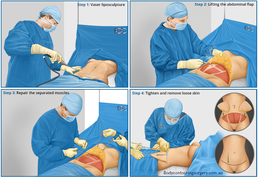 What Does an Abdominoplasty Do to Your Belly Button