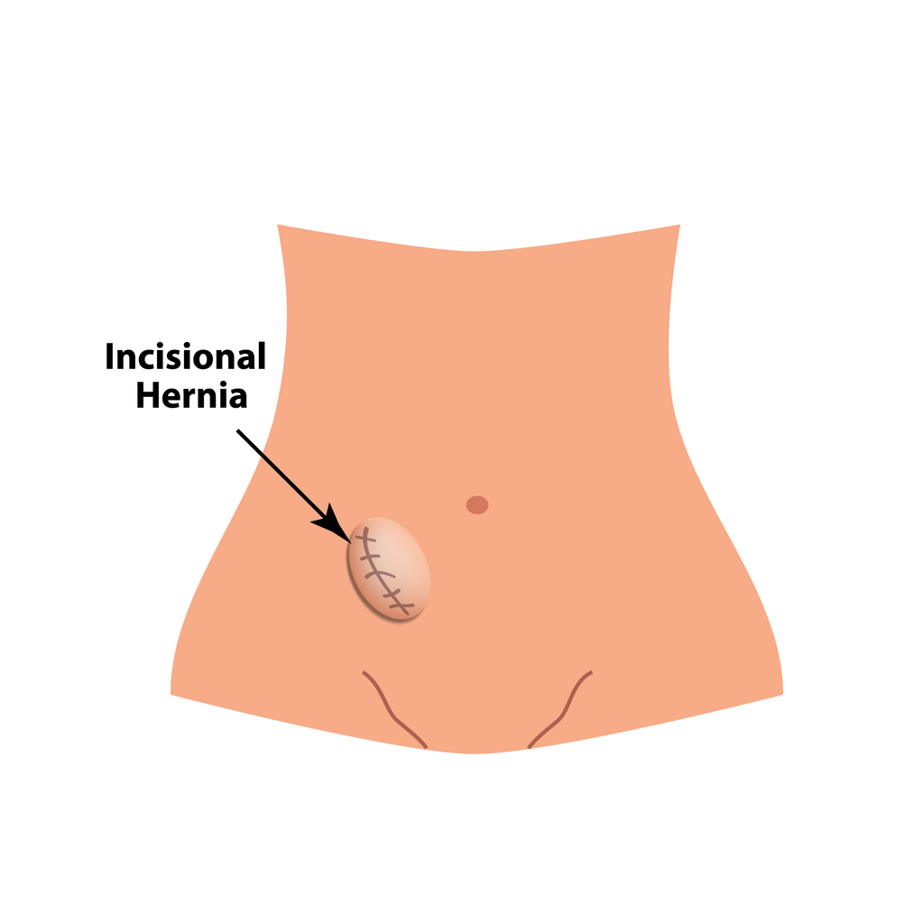 Incisional hernia