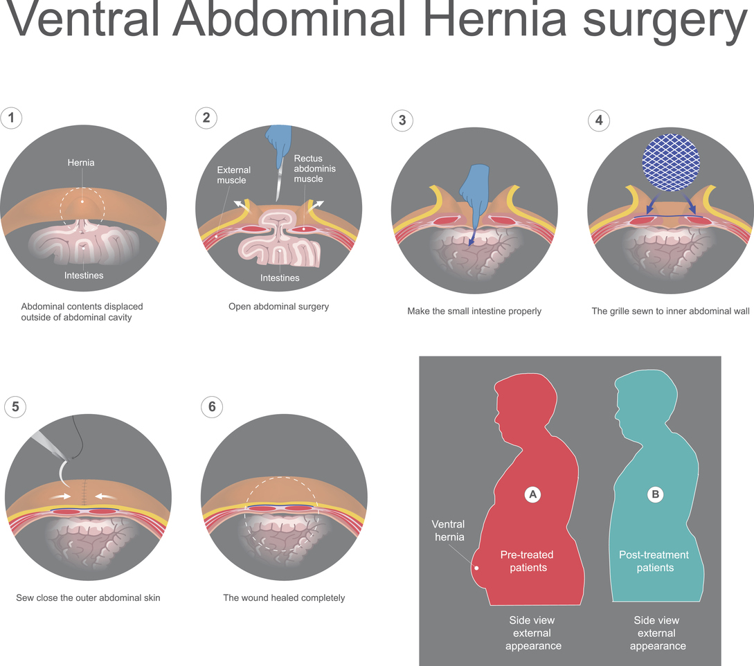 Ventral hernia surgery repair