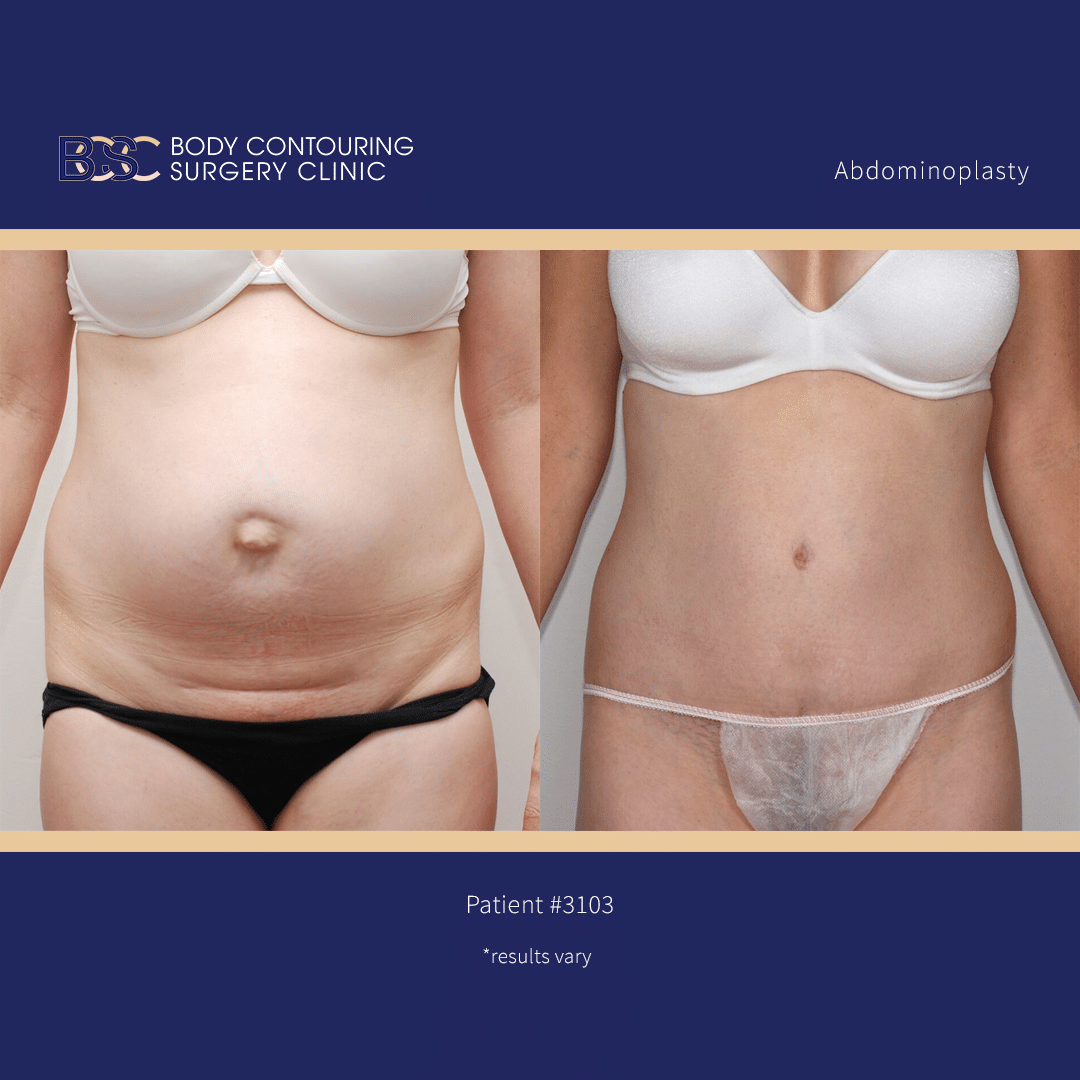 Patient with abdominal muscle separation repaired with Abdominoplasty