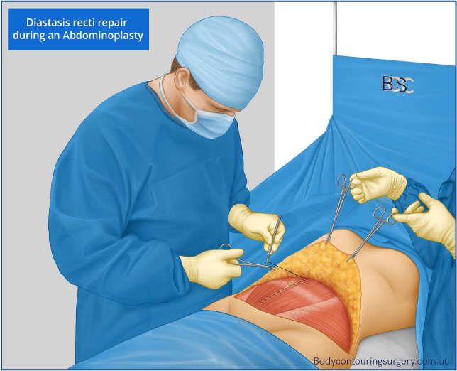 Repair of diastasis recti during an abdominoplasty