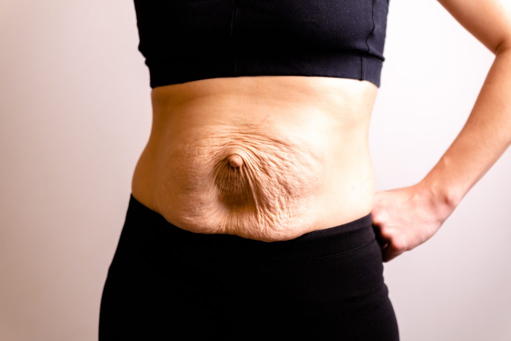 woman with muscle separation (diastasis recti)