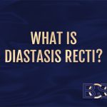 Everything You Need to Know about Diastasis Recti