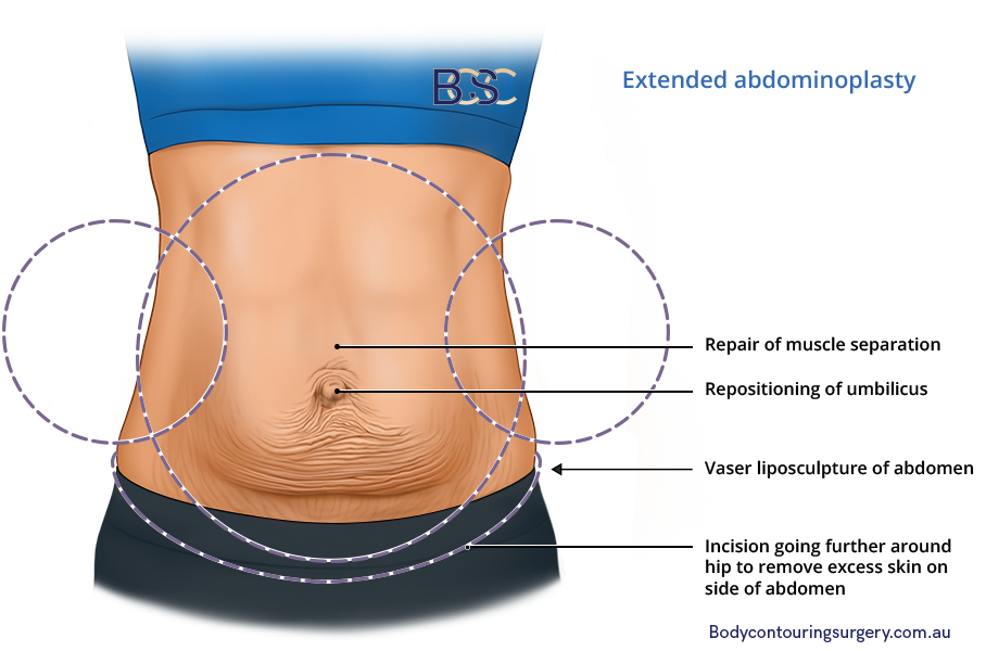 Extended abdominoplasty illustration