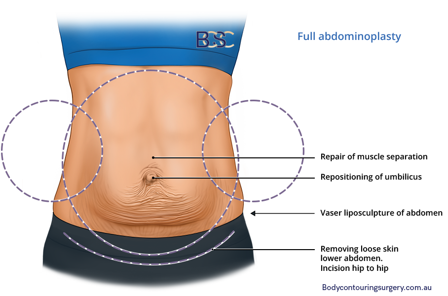 Full abdominoplasty illustration