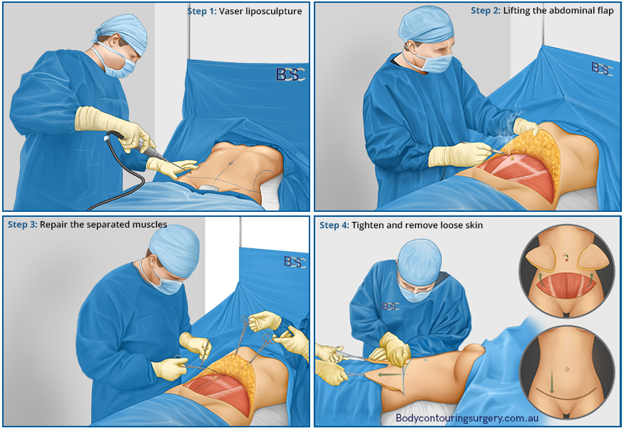 Steps in an abdominoplasty surgery