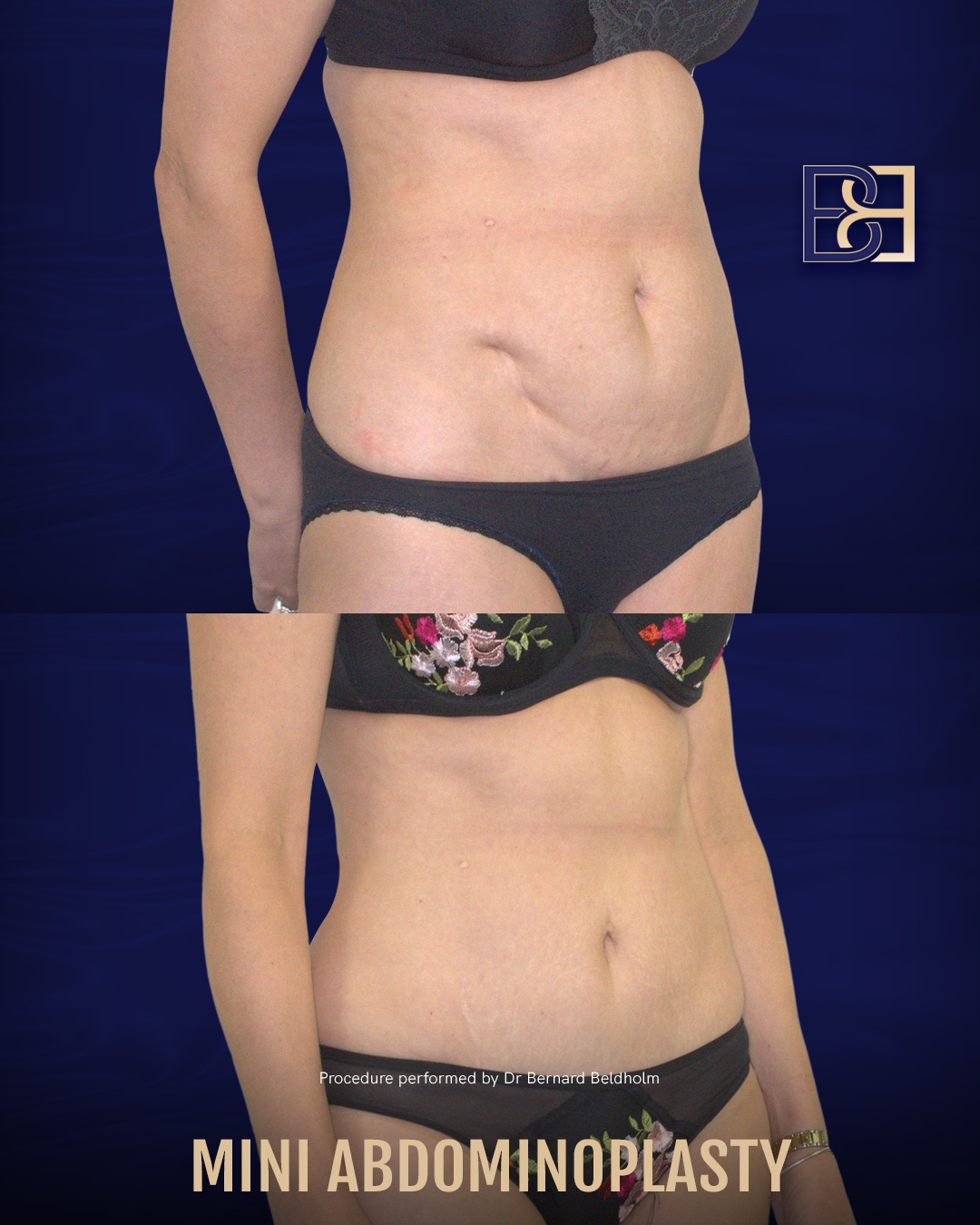 Abdominoplasty Vs Lipectomy Body Contouring Surgery