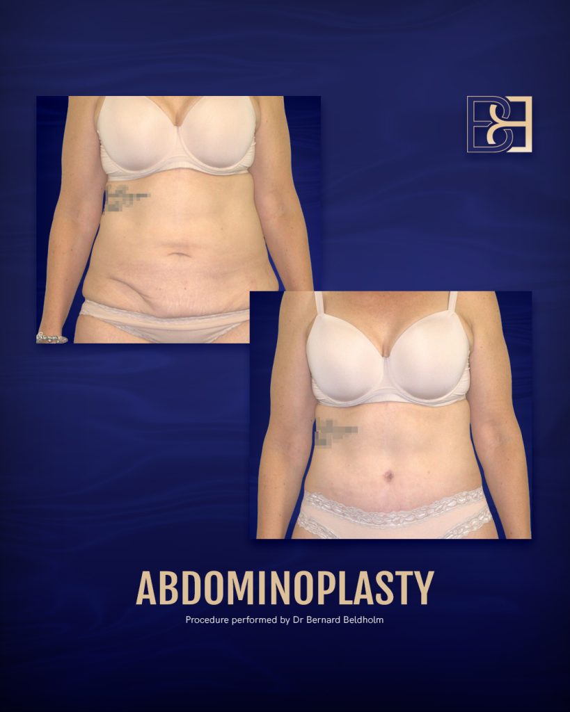 What to Expect When Recovering From a Mini-abdominoplasty