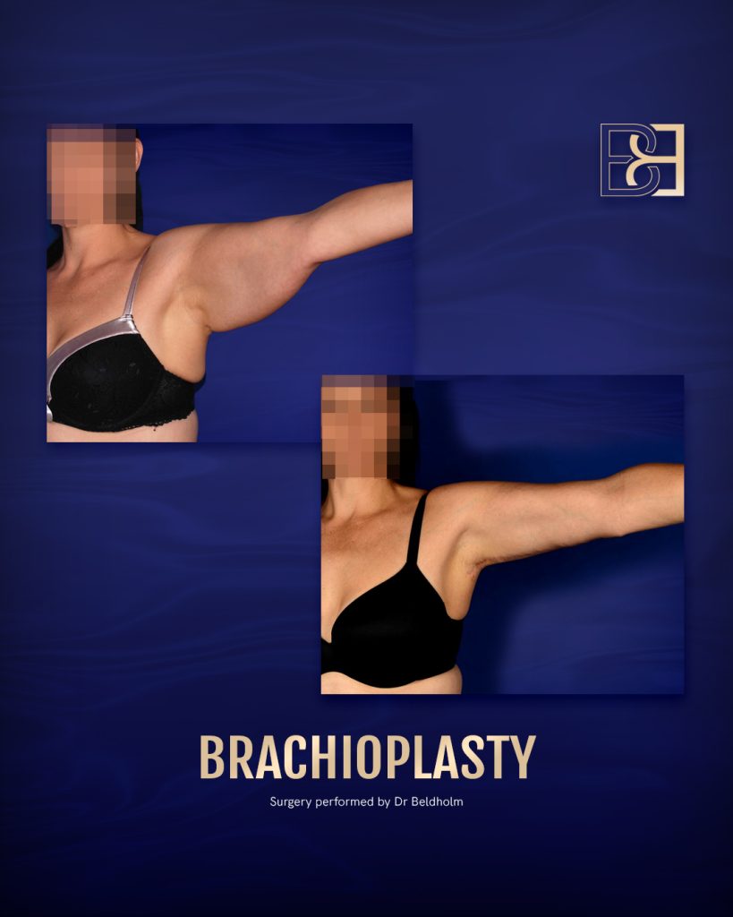 Brachioplasty or Arm Lift