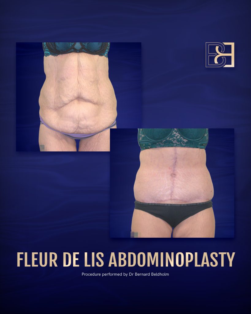 Abdominoplasty Vs. Lipectomy - Body Contouring Surgery