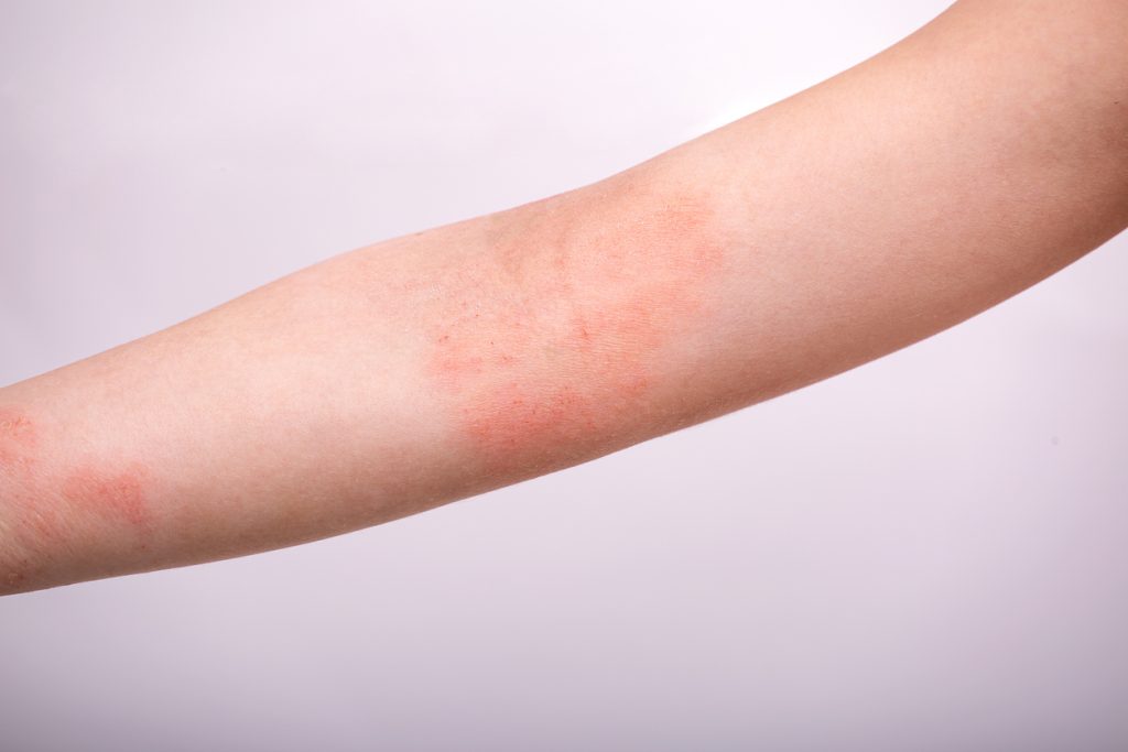 Incredible Benefits of Arm Lift Surgery - It can reduce skin rashes