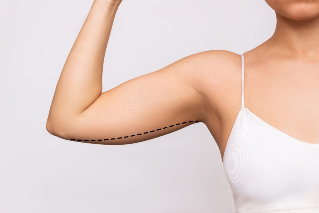 Incredible Benefits of Arm Lift Surgery - It may make it easier to see your biceps