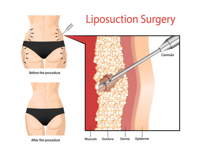 VASER Liposuction - Body Contouring Surgery Clinic Pty Ltd