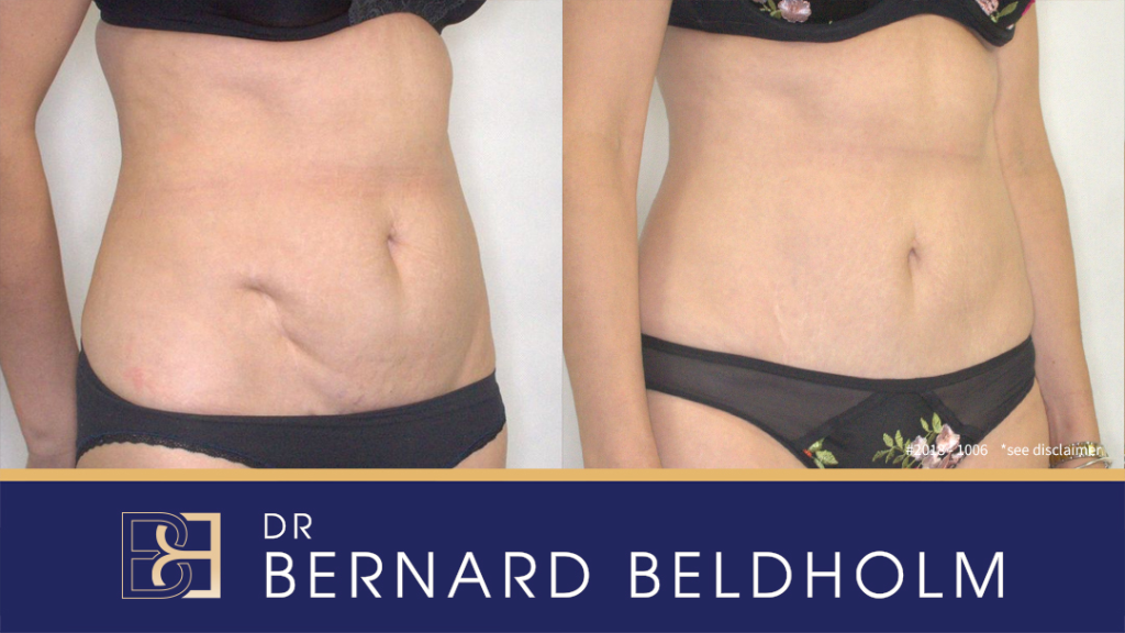 Tummy Tuck Recovery  What To Expect After Abdominoplasty