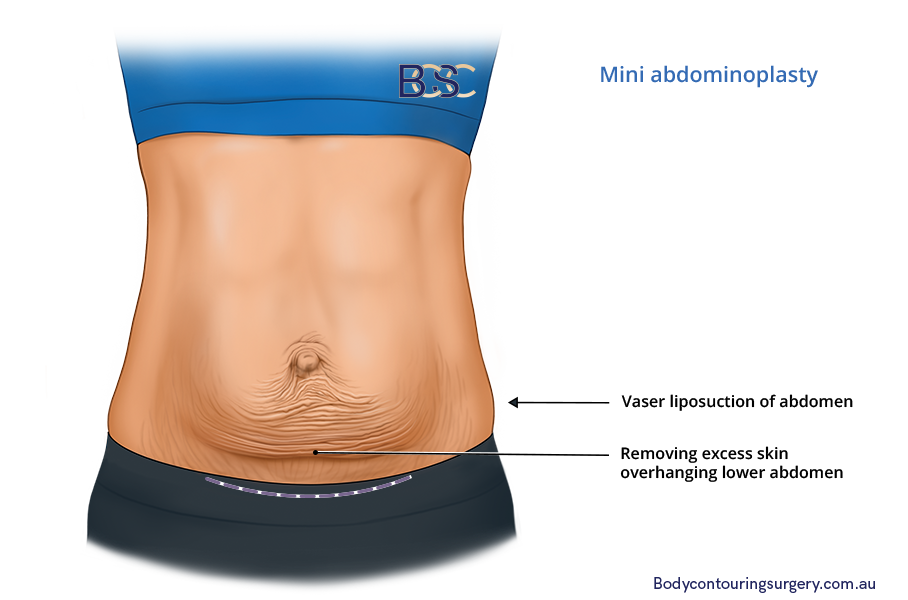 What is a Mini Abdominoplasty